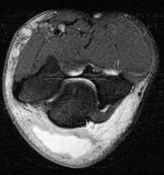 Figure 4 for case olecranon bursitis ( RID2082 )